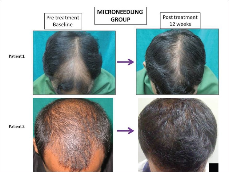 A Randomized Evaluator Blinded Study of Effect of Microneedling in Androgenetic Alopecia: A Pilot Study（Figure 6.）