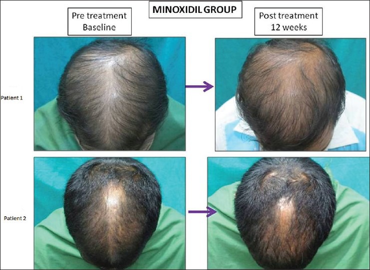A Randomized Evaluator Blinded Study of Effect of Microneedling in Androgenetic Alopecia: A Pilot Study（Figure 7.）