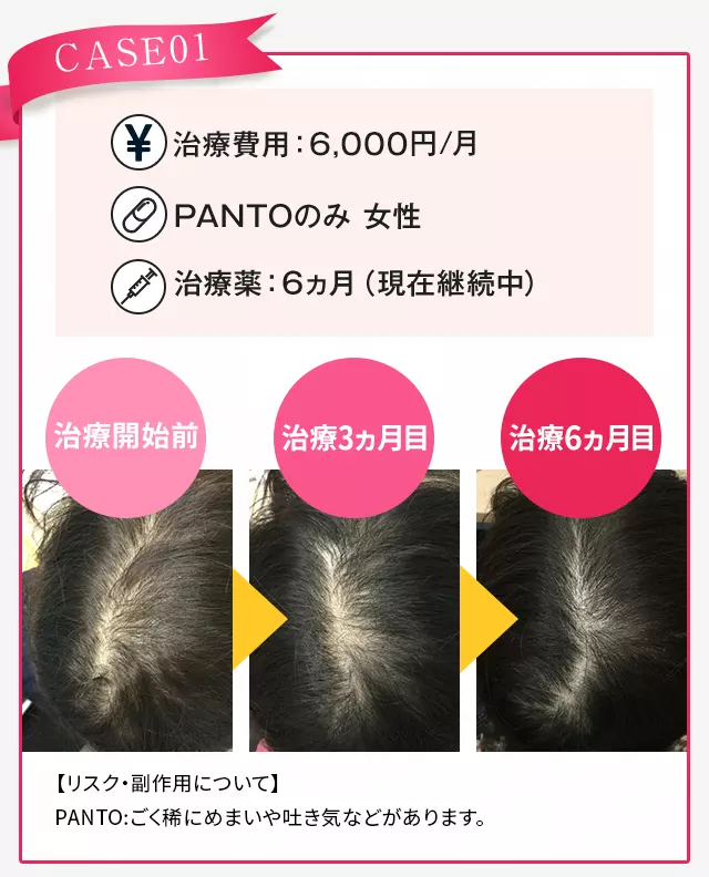 AGAヘアクリニックFAGA治療症例1