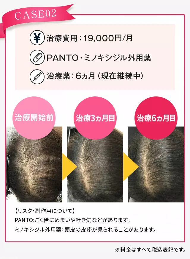 AGAヘアクリニックFAGA治療症例2