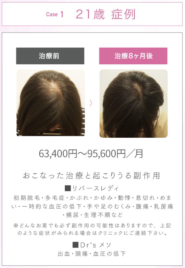 AGAスキンクリニックFAGA治療症例1