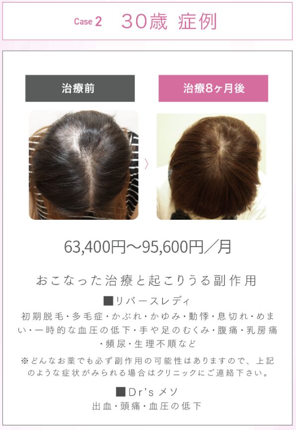 AGAスキンクリニックFAGA治療症例2