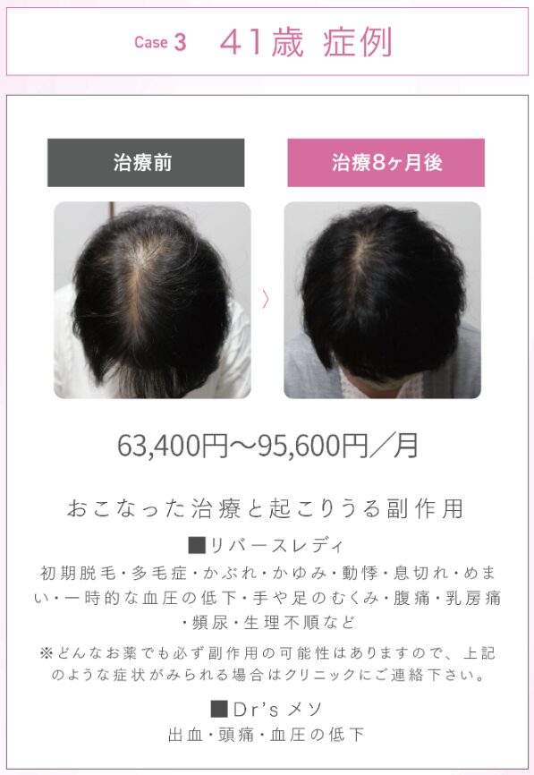 AGAスキンクリニックFAGA治療症例3