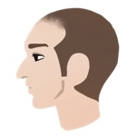 AGAのⅡ a型の横顔イラスト