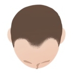AGAのⅡ a型の頭皮真上イラスト