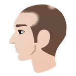AGAのⅡ Vertex型の横顔イラスト