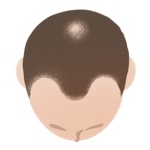 AGAのⅡ Vertex型の頭皮真上イラスト