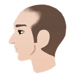 AGAのⅢ a型の横顔イラスト