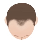 AGAのⅢ a型の頭皮真上イラスト