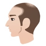 AGAのⅢ Vertex型の横顔イラスト