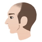 AGAのⅣ a型の横顔イラスト
