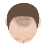 AGAのⅣ a型の頭皮真上イラスト