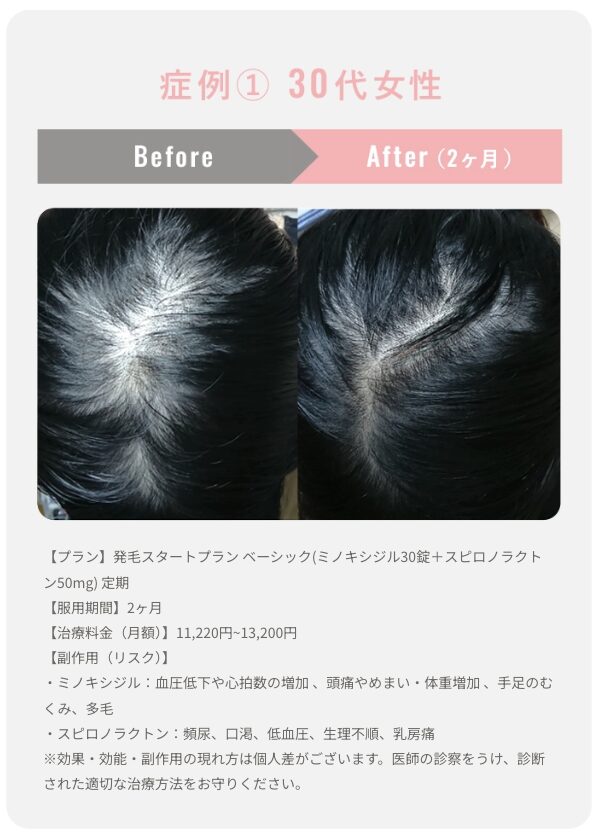 クリニックフォアFAGA症例1