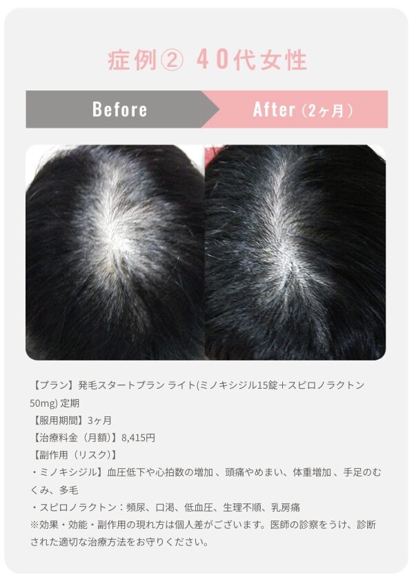 クリニックフォアFAGA症例2