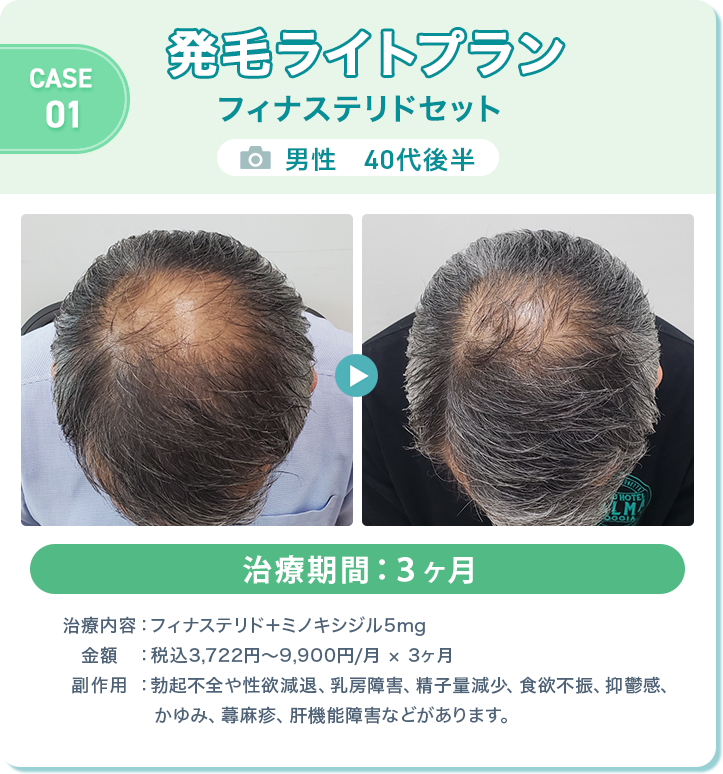 オンラインAGA治療（男性）症例画像1