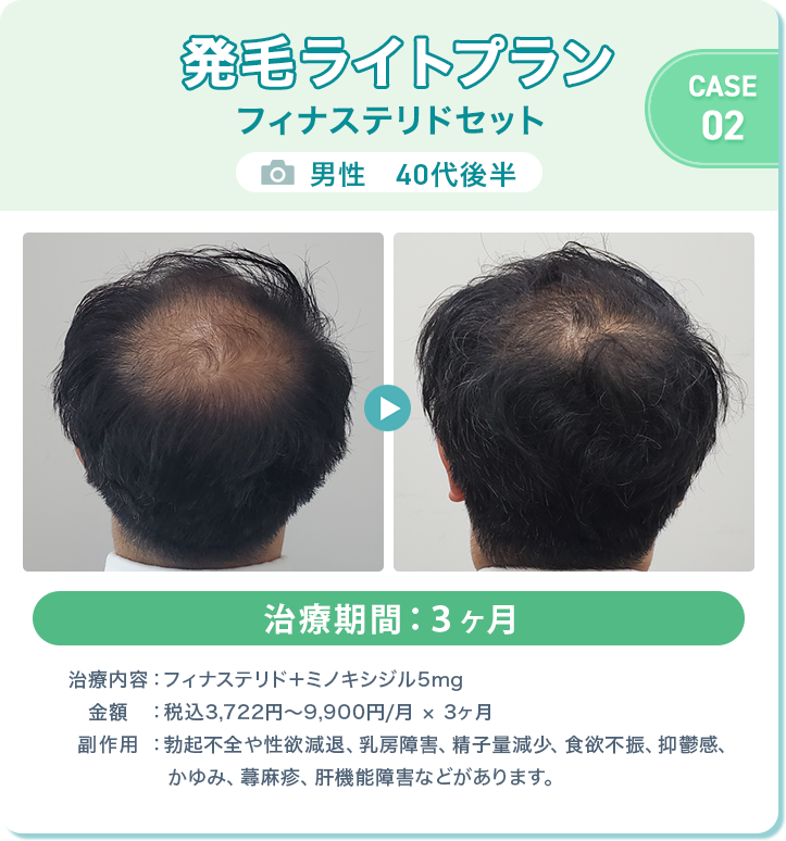 オンラインAGA治療（男性）症例画像2