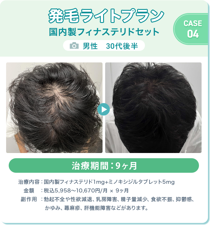 オンラインAGA治療（男性）症例画像4