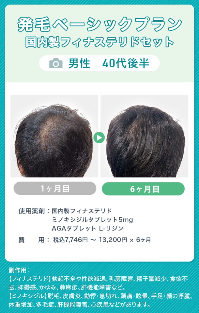 オンラインAGA治療（男性）症例画像1