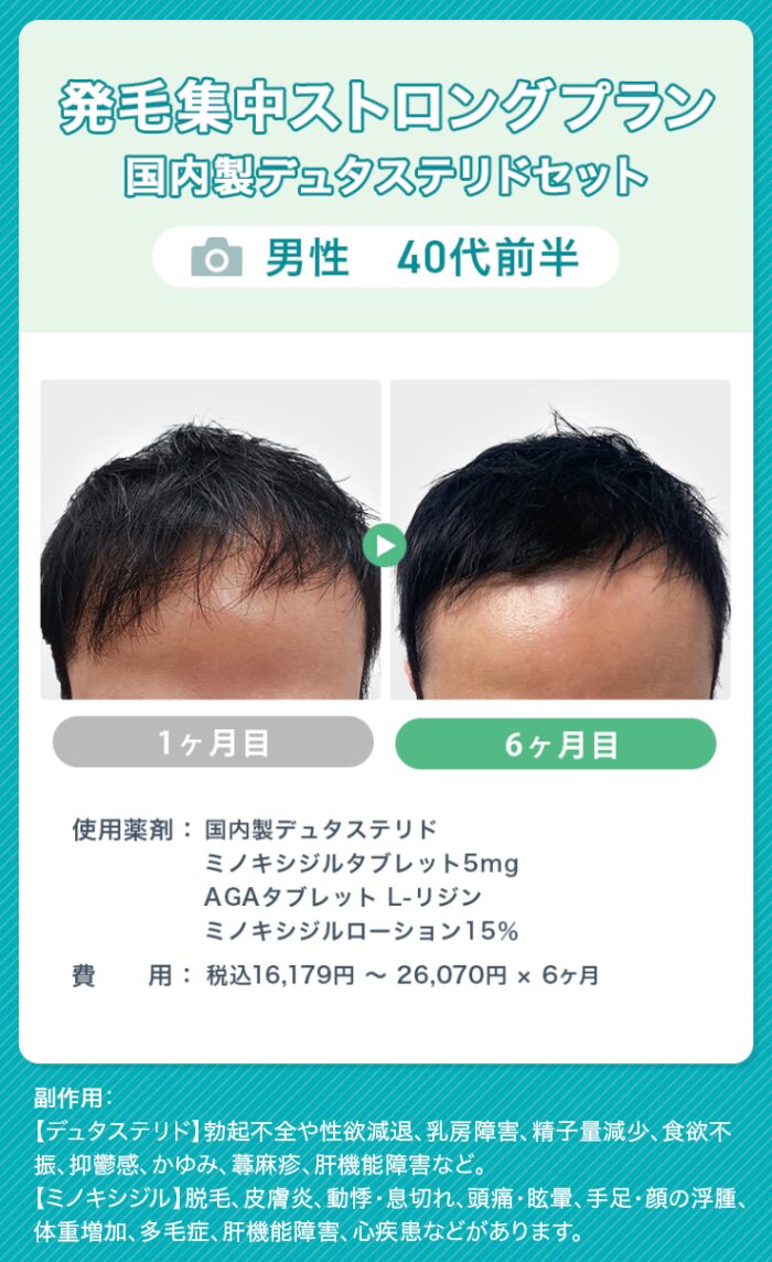 オンラインAGA治療（男性）症例画像2