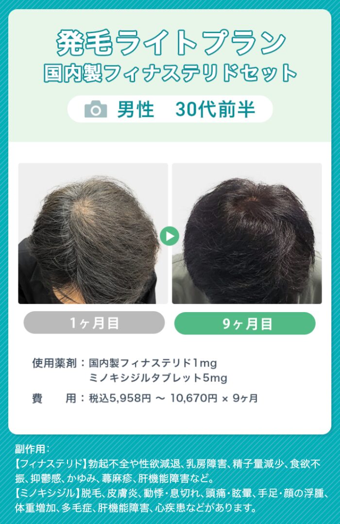 オンラインAGA治療（男性）症例画像3