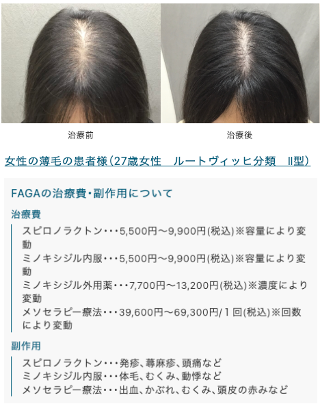 駅前AGAクリニックFAGA治療症例1