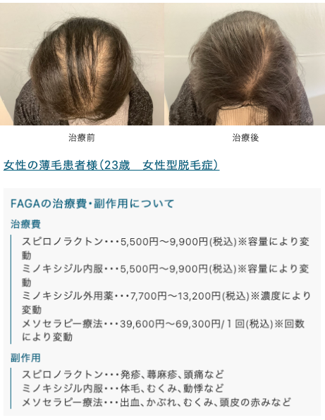 駅前AGAクリニックFAGA治療症例2