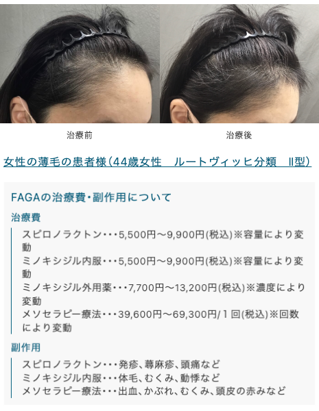 駅前AGAクリニックFAGA治療症例3