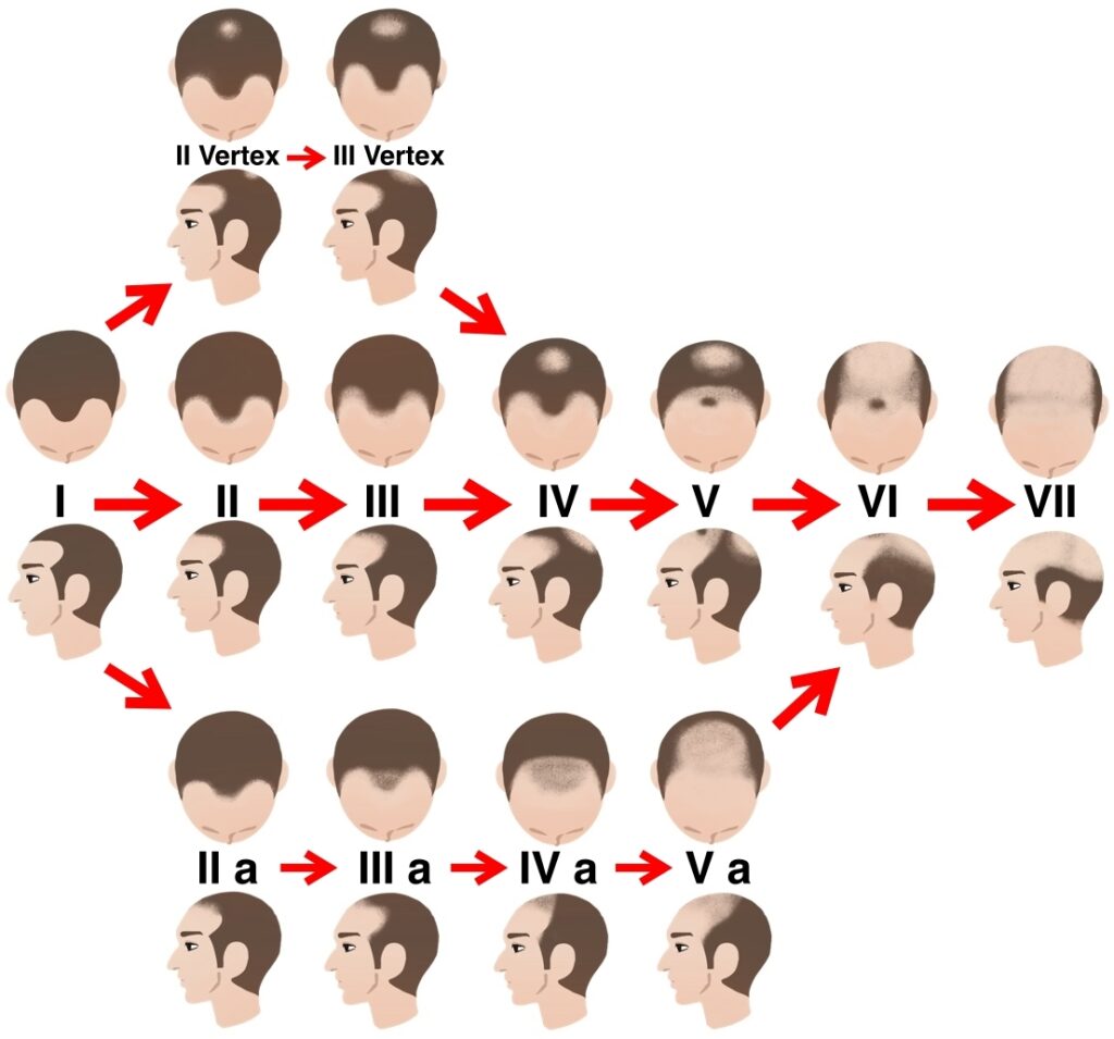 男性の薄毛の進行状況の解説図