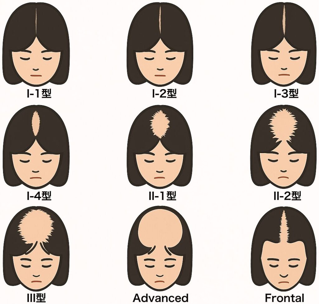 女性の薄毛の進行状況の解説図