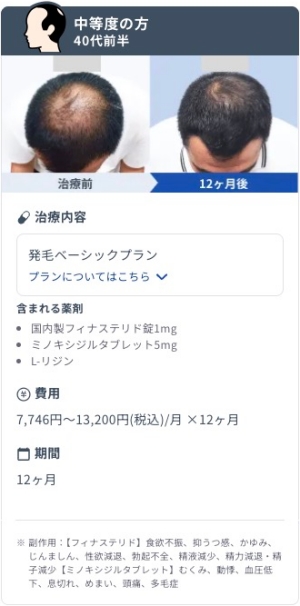 DMMオンラインクリニックで発毛ベーシックプランを12ヶ月継続した40代前半・中等度AGA男性のビフォーアフター症例