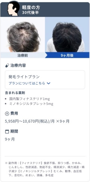 DMMオンラインクリニックで発毛ライトプランを9ヶ月継続した30代後半・軽度AGA男性のビフォーアフター症例