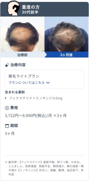 DMMオンラインクリニックで発毛ライトプランを3ヶ月継続した30代前半・重度AGA男性のビフォーアフター症例