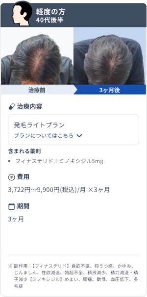 DMMオンラインクリニックで発毛ライトプランを3ヶ月継続した40代後半・軽度AGA男性のビフォーアフター症例