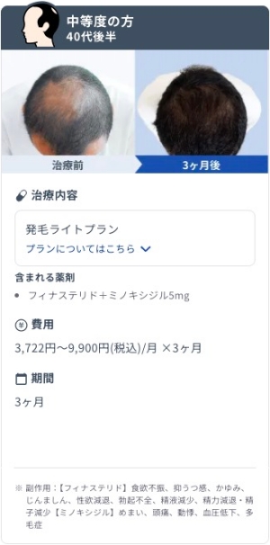 DMMオンラインクリニックで発毛ライトプランを3ヶ月継続した40代後半・中等度AGA男性のビフォーアフター症例