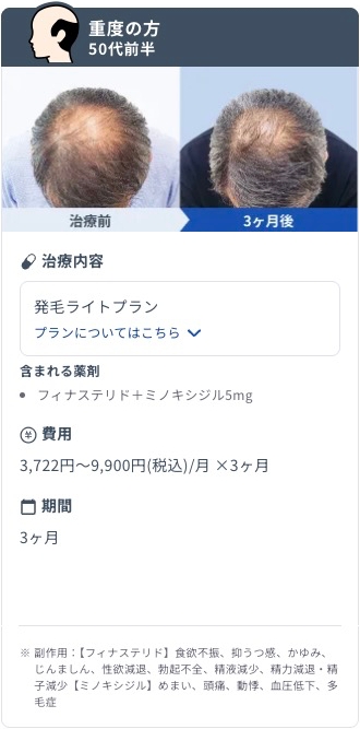 DMMオンラインクリニックで発毛ライトプランを3ヶ月継続した50代前半・重度AGA男性のビフォーアフター症例