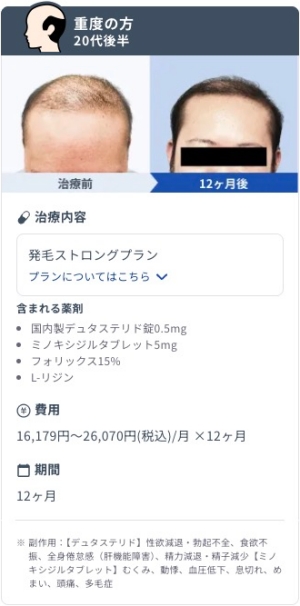 DMMオンラインクリニックで発毛ストロングプランを12ヶ月継続した20代後半・重度AGA男性のビフォーアフター症例