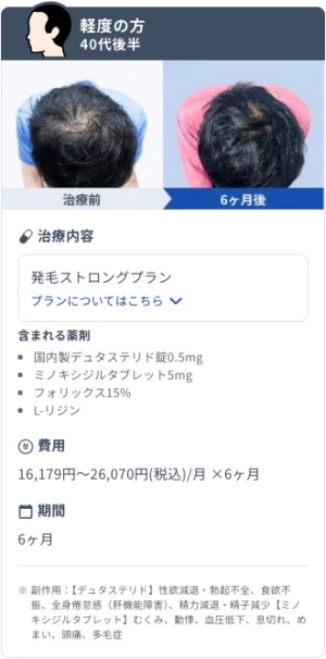 DMMオンラインクリニックで発毛ストロングプランを6ヶ月継続した40代後半・軽度AGA男性のビフォーアフター症例