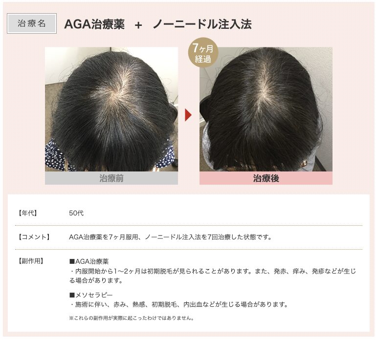 スマイルAGAクリニックFAGA治療症例1