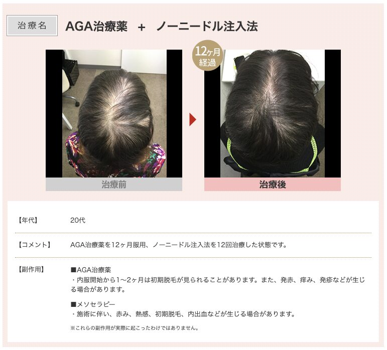 スマイルAGAクリニックFAGA治療症例2