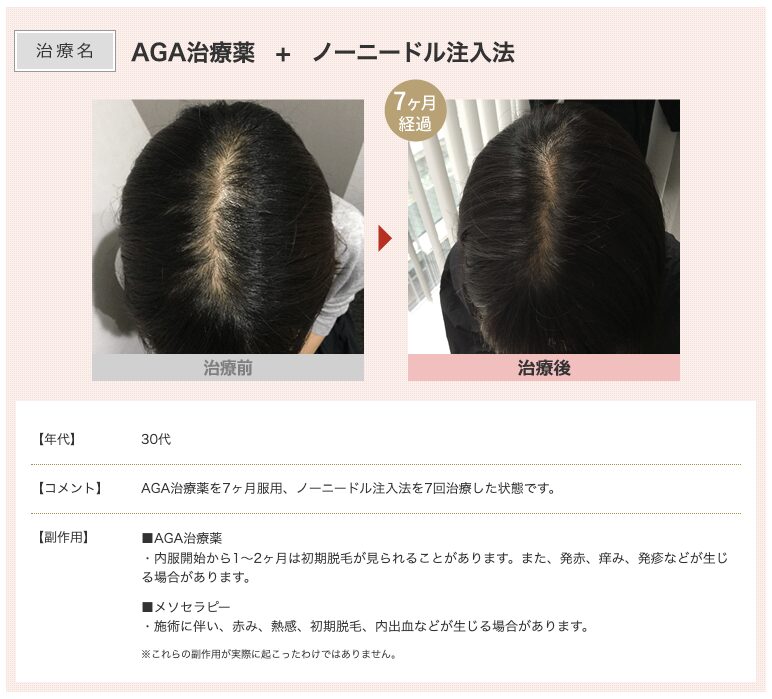 スマイルAGAクリニックFAGA治療症例3